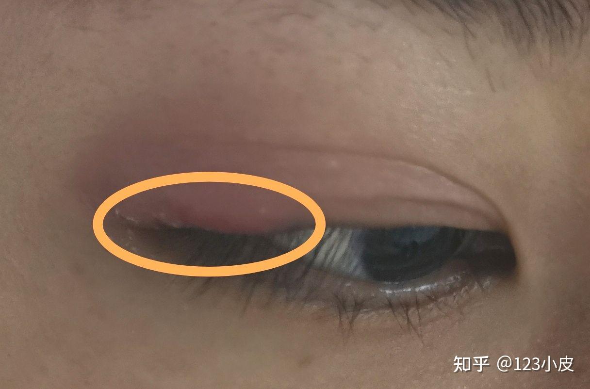 记录眼睛麦粒肿的发展过程 - 知乎