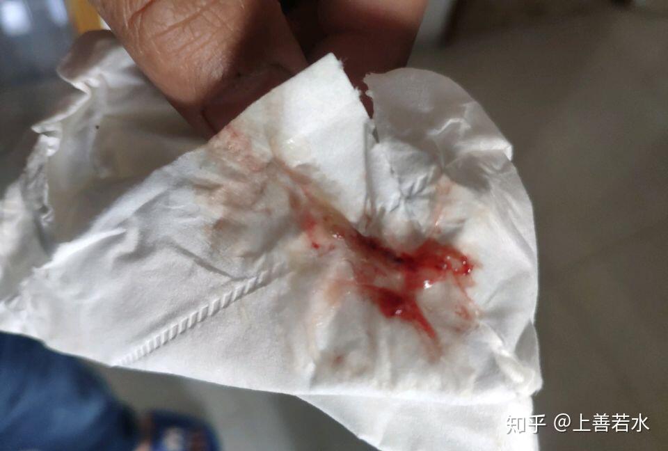 我的悲惨惨惨惨惨惨的鼻炎经历