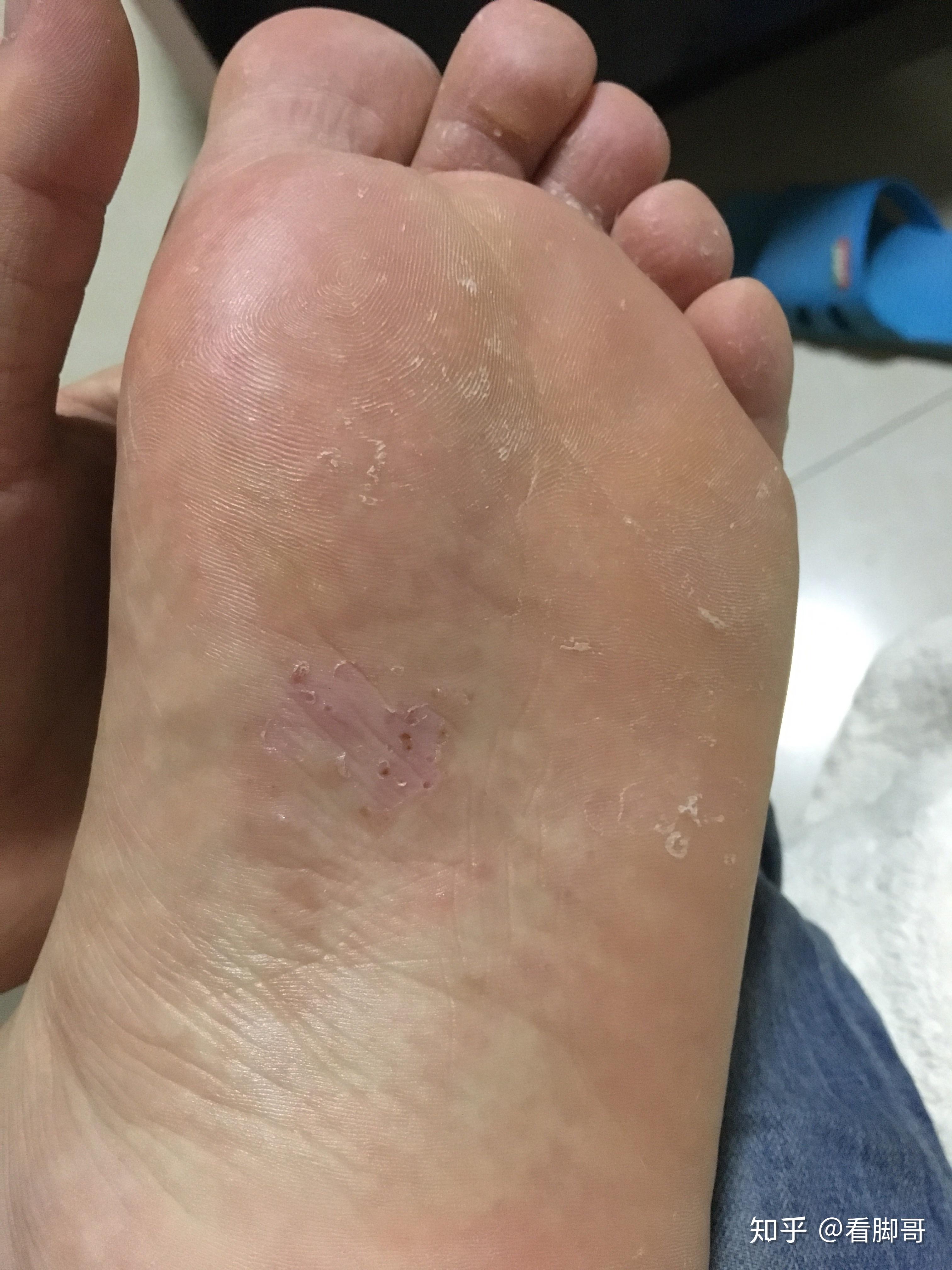 脚上有湿疹+足癣？伴有真菌感染的湿疹该怎么用药？ - 知乎
