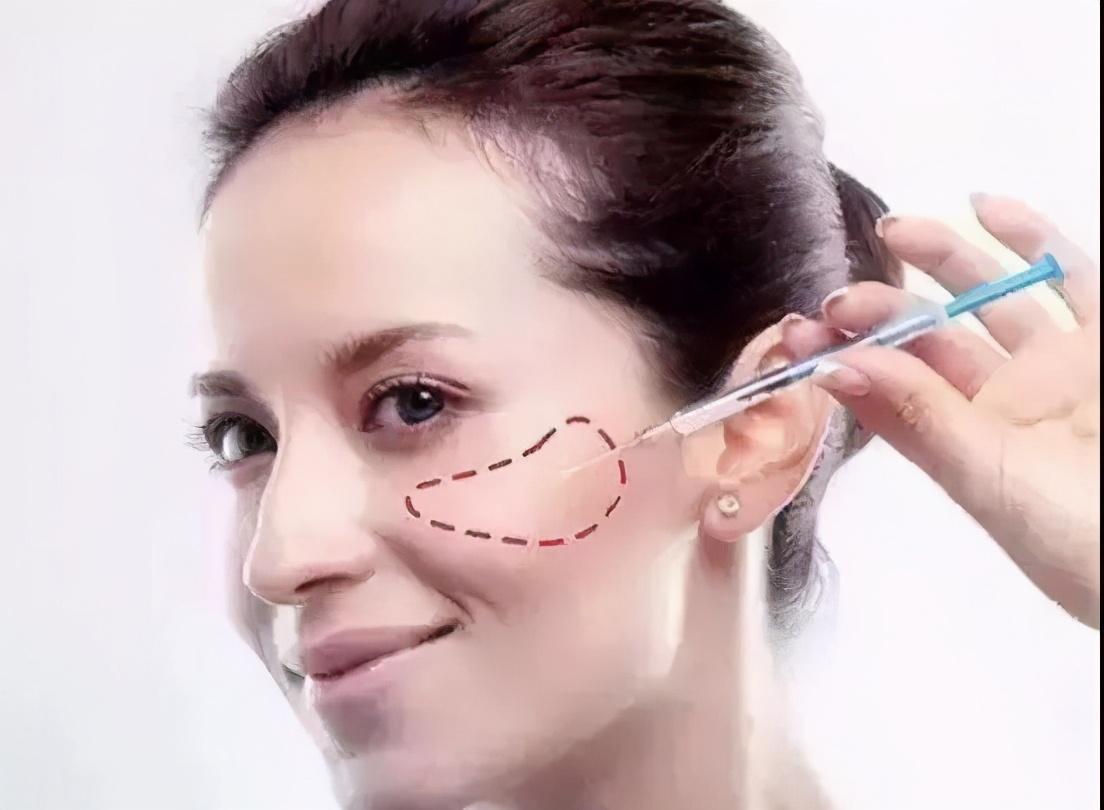 填充苹果肌的常见方法 - 知乎