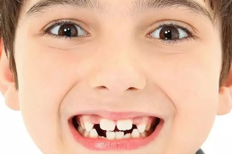 医生,我家孩子的门牙变成了大板牙,这是怎么回事呀?