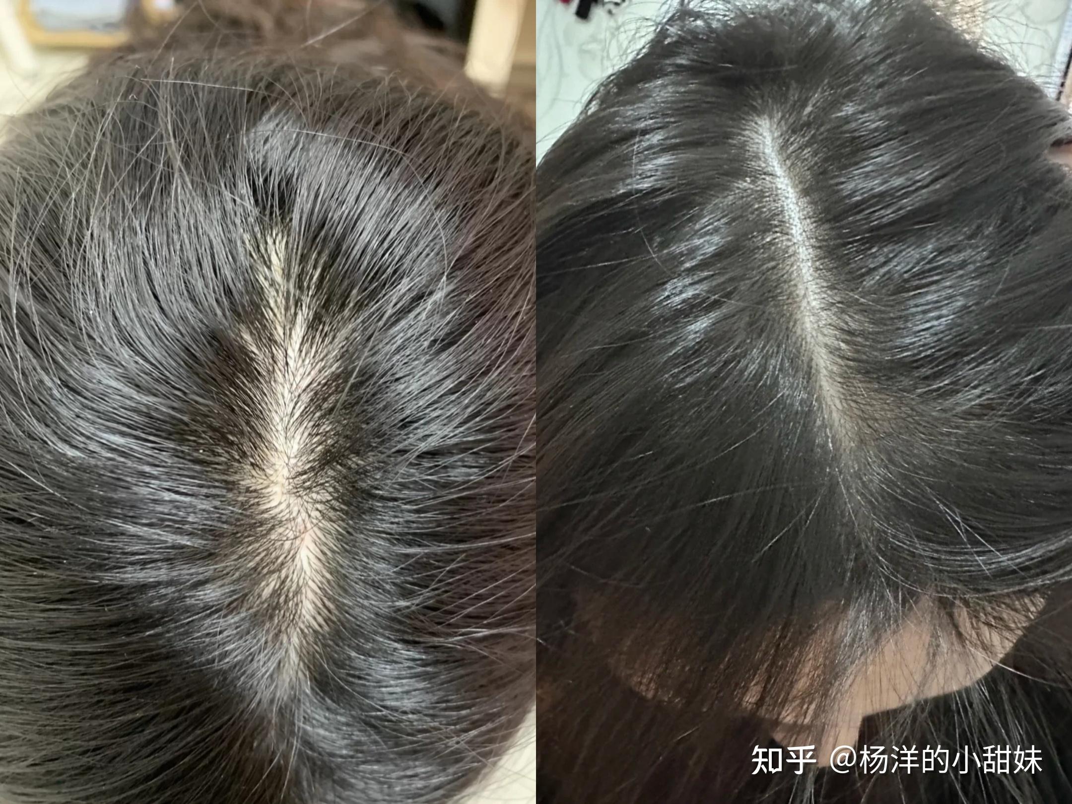 使用中科院博士推荐的育发液,真的能改善头顶发缝宽,头发稀疏等问题?