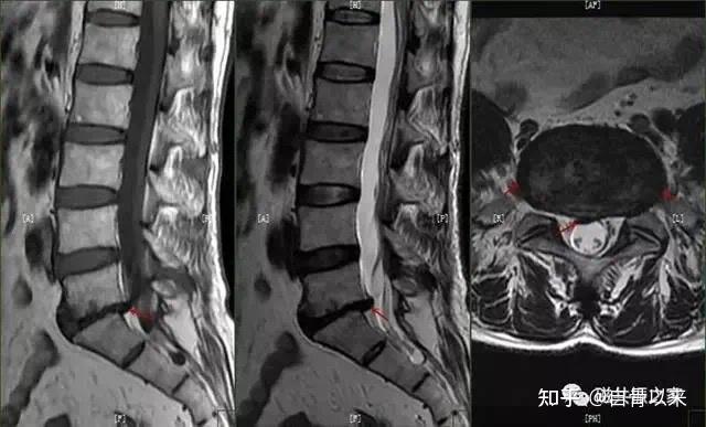 腰椎间盘突出ct片子怎么看教你看腰椎间盘突出ct影像学表现