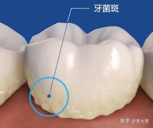 牙齒矯正正畸務必注意遠離19大禁忌陷阱