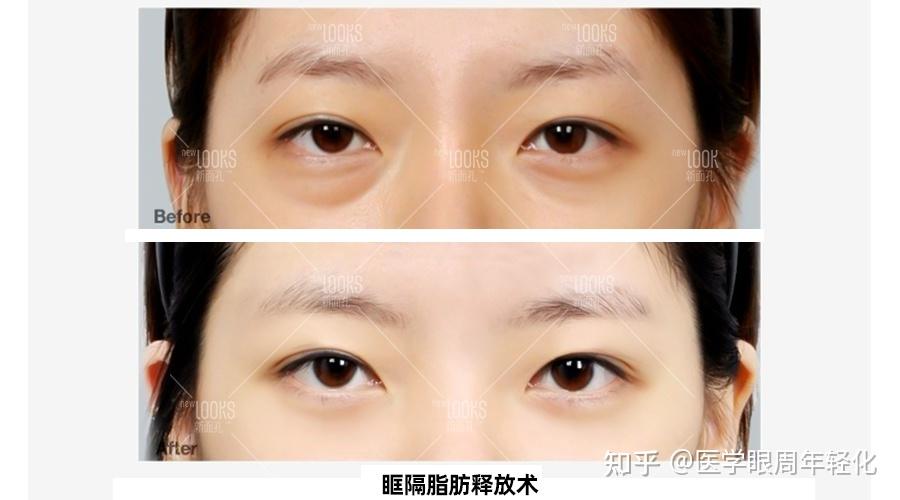 祛眼袋可以做眶隔脂肪释放术吗？ - 知乎