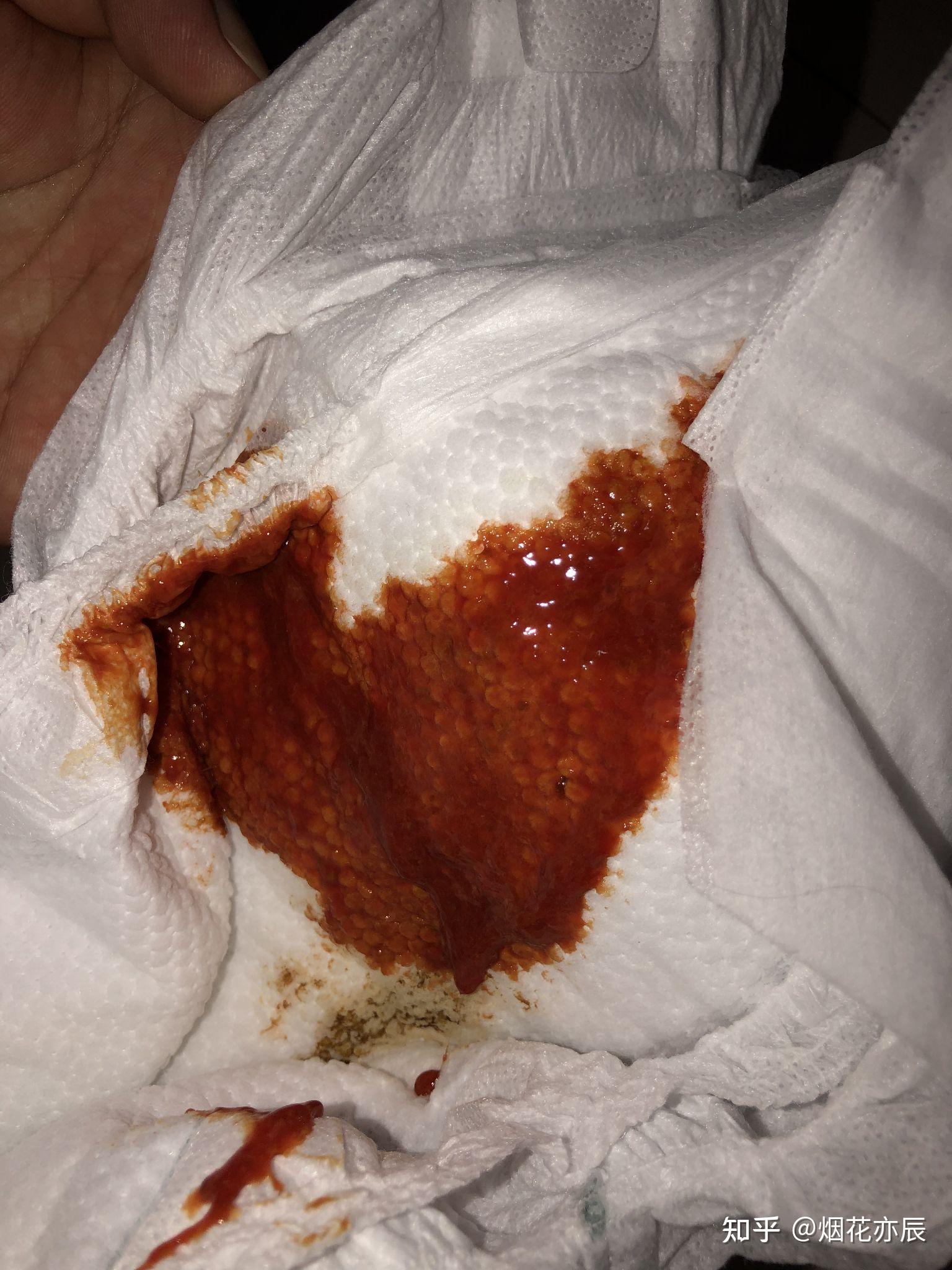 宝宝血便便怎么办血常规白细胞一个隐血阳性