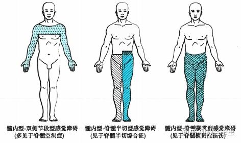 为病变对侧平面以下痛,温觉缺失而触觉和深感觉保存(分离性感觉障碍)