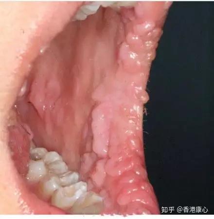 hpv感染口腔的表现图片图片