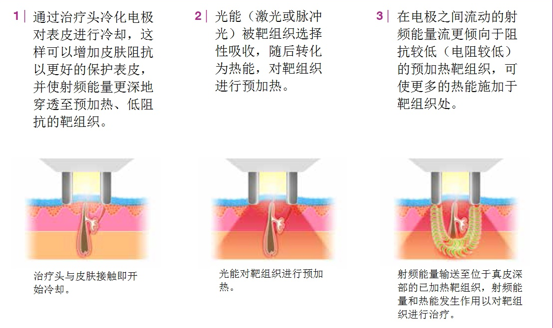 美容设备公司赛诺龙引进中国的e光技术?