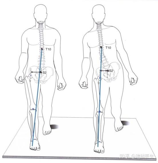 公众号)云中瑞麟(id: ruilinfly)步态[2]异常步态障碍分类支撑相障碍