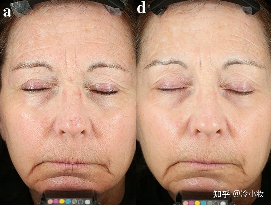 透明质酸对皮肤的作用