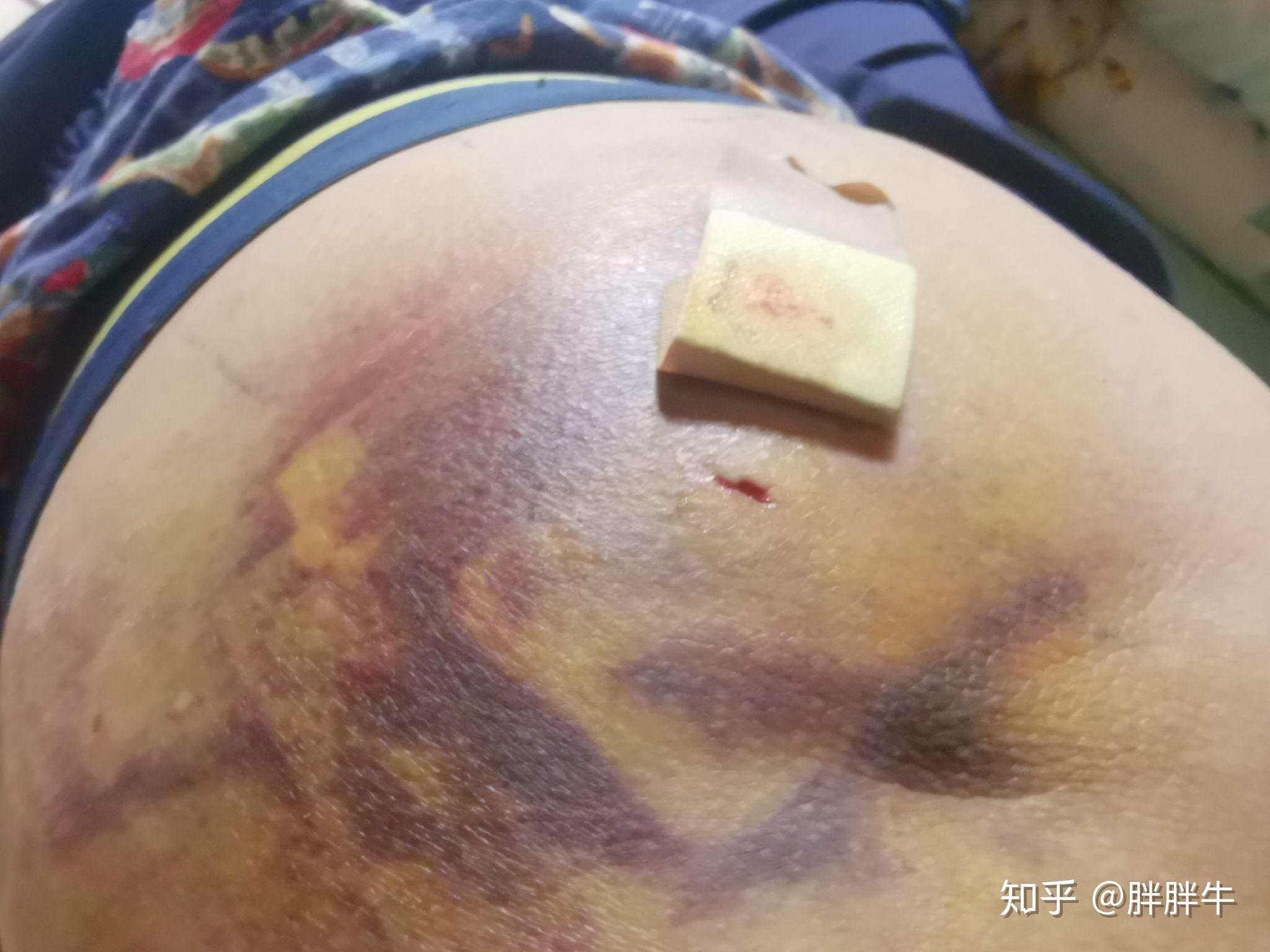 臀肌挛缩详细纪实希望能帮到需要帮助的病友们