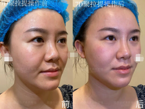 7d聚拉提值不值得做效果好吗