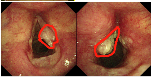 喉癌插管手术和图片图片