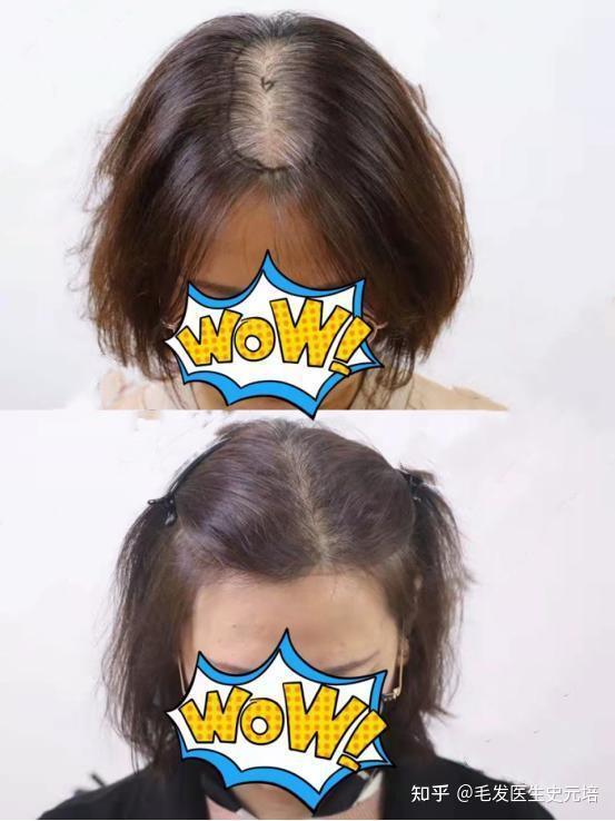 为什么女性发缝处位置更容易脱发呢? - 知乎
