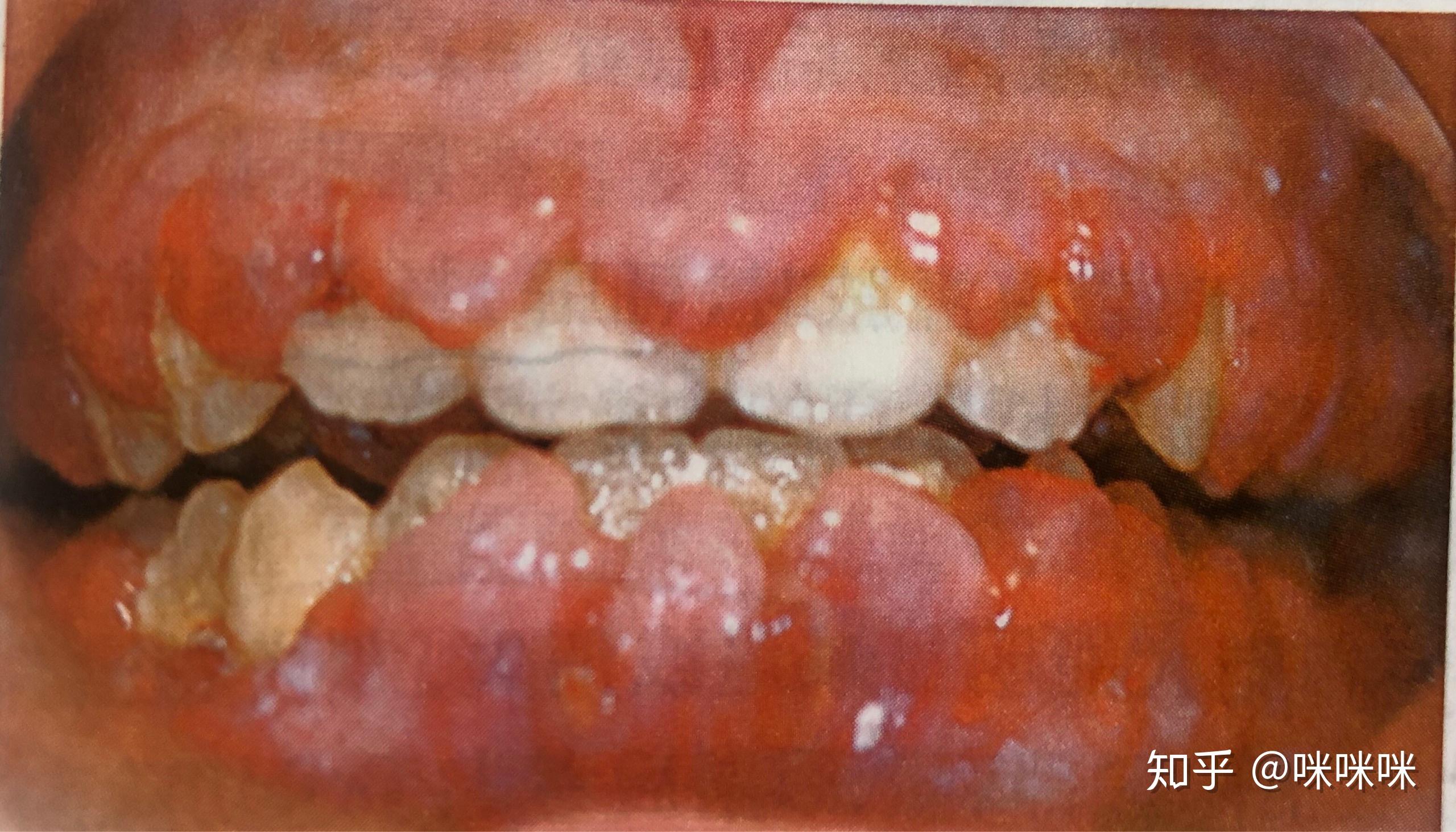 白血病引起的牙龈增生出血