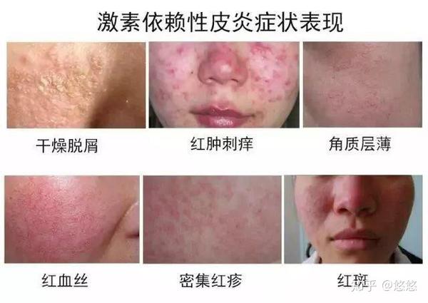 皮肤过敏起红疹角质层薄遇热又干又痒怎么办 知乎
