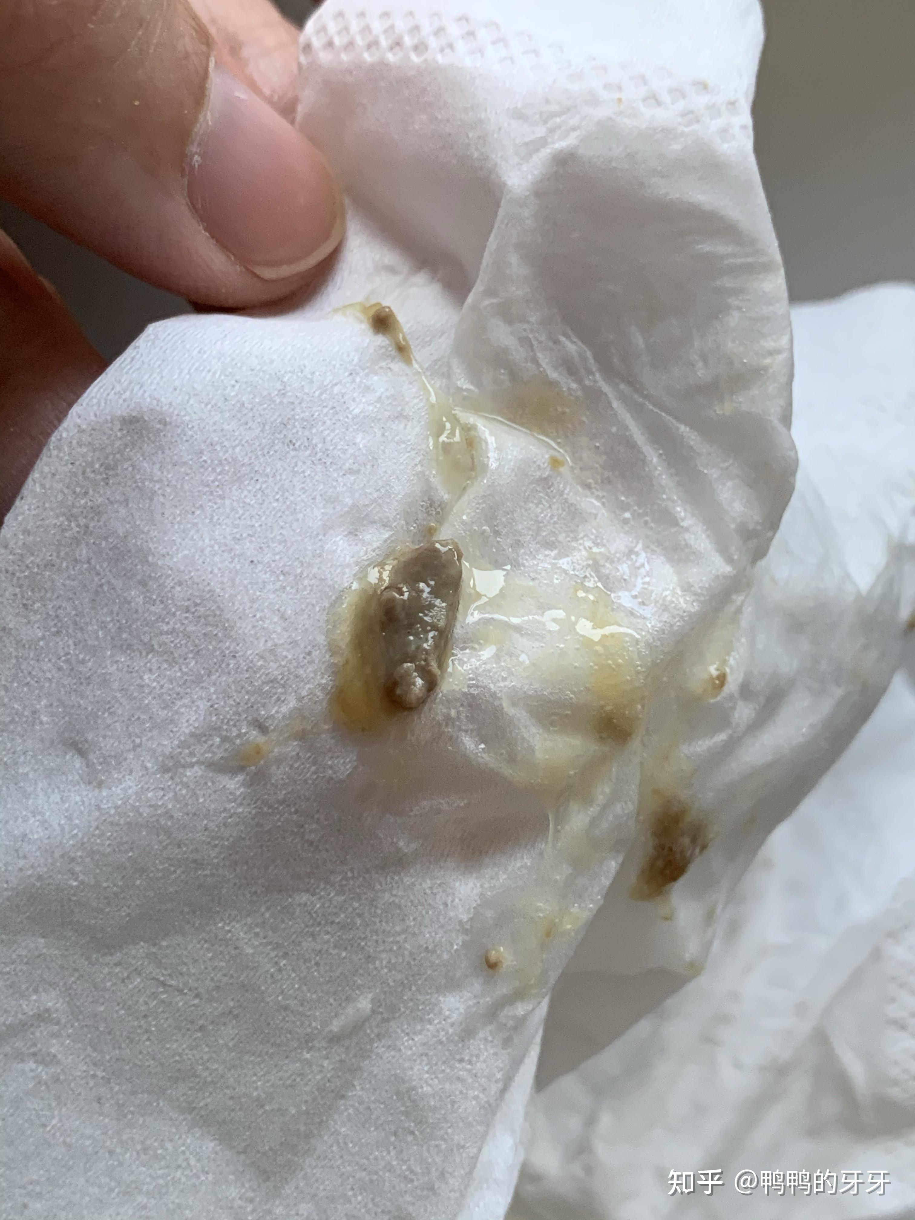 鼻窦炎需要手术的一定不能拖!