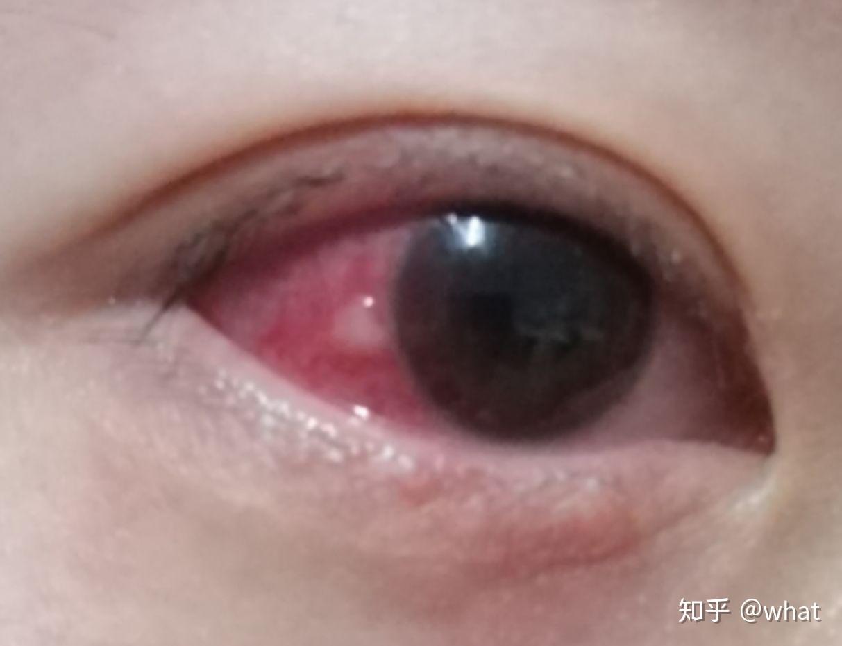 被结膜炎折磨了十多年的我。 - 知乎