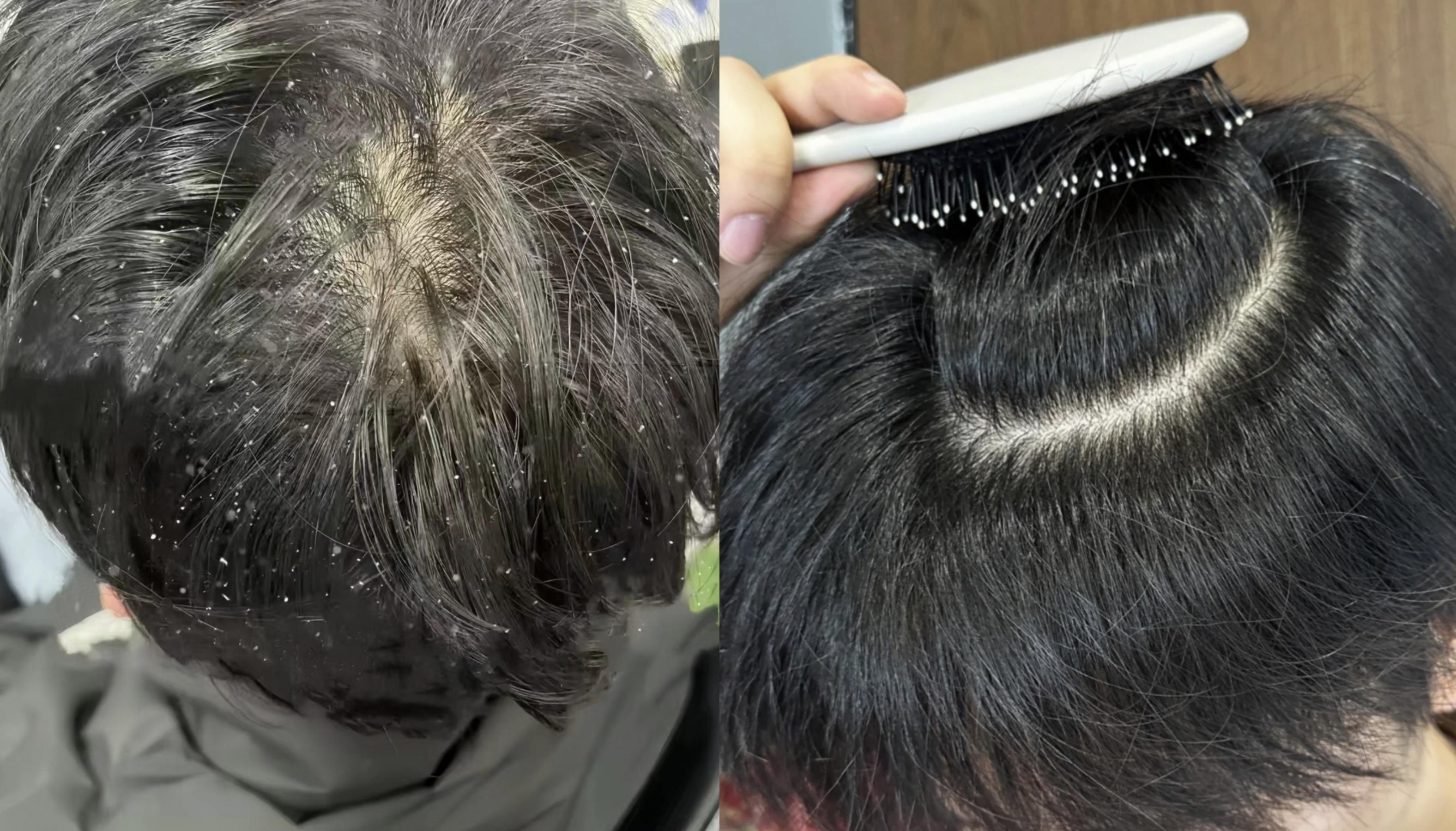 男生头屑如雪尴尬到扣脚?大多数直男不知道的祛屑方案:两招轻松秒变清爽男神! - 知乎