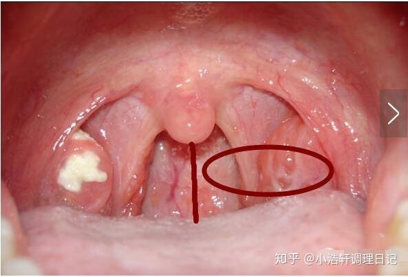 扁桃体肿大的三度划分 一度二度三度 讲解 知乎