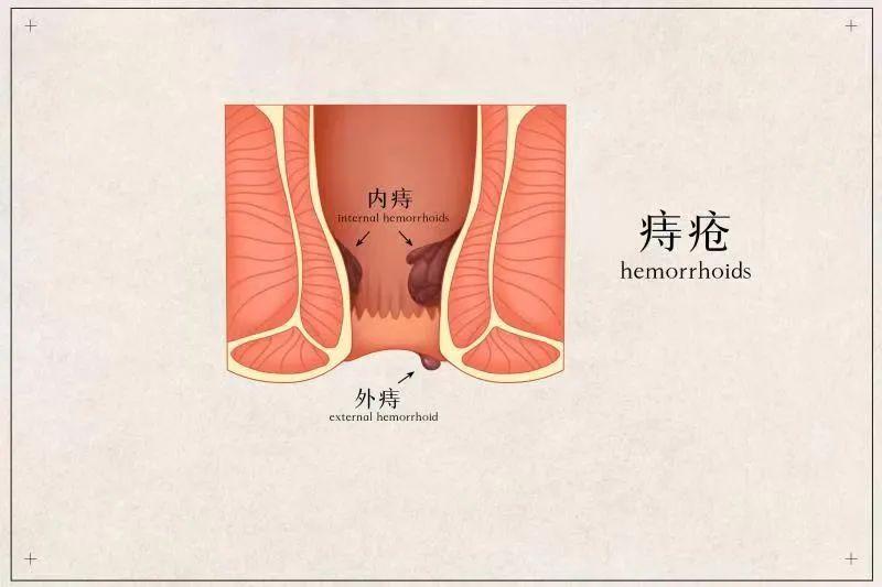04肛管炎症/肛周脓肿:肛管炎症或者是肛周脓肿,导致局部产生红,肿,热