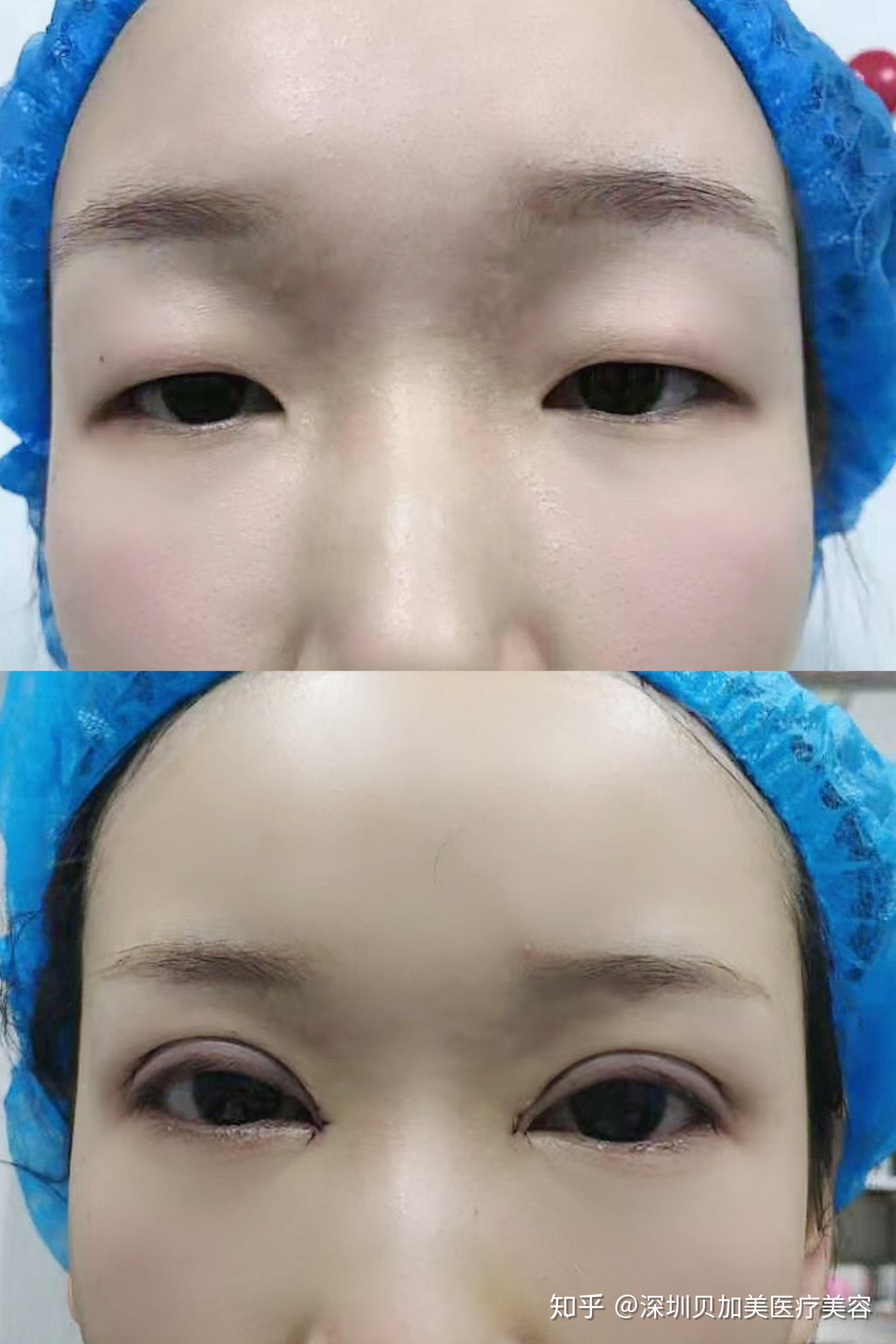 内眼角修复案例：开内眼角后出现了豁口、圆钝、疤痕怎么办？通过解剖复位还原初眼状态 - 知乎