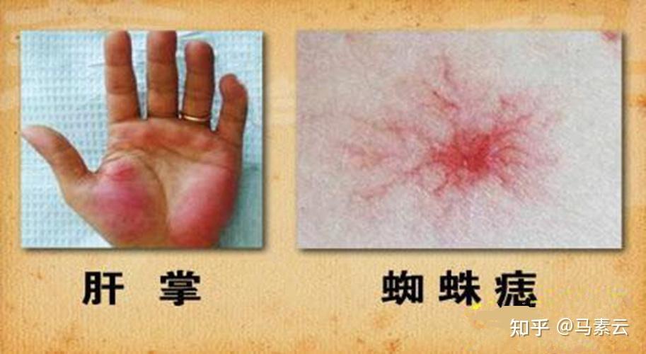 近期手掌发红呈红色斑点、斑块,压迫后变成苍白色是怎么回事? - 知乎