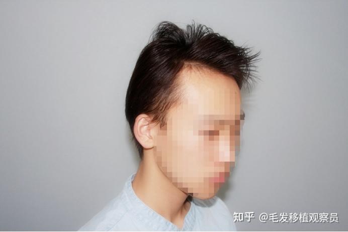 
做完植发能吃鱼吗知乎
