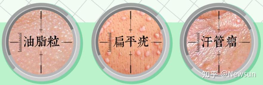 疣 VS 其它皮肤粒粒 - 知乎