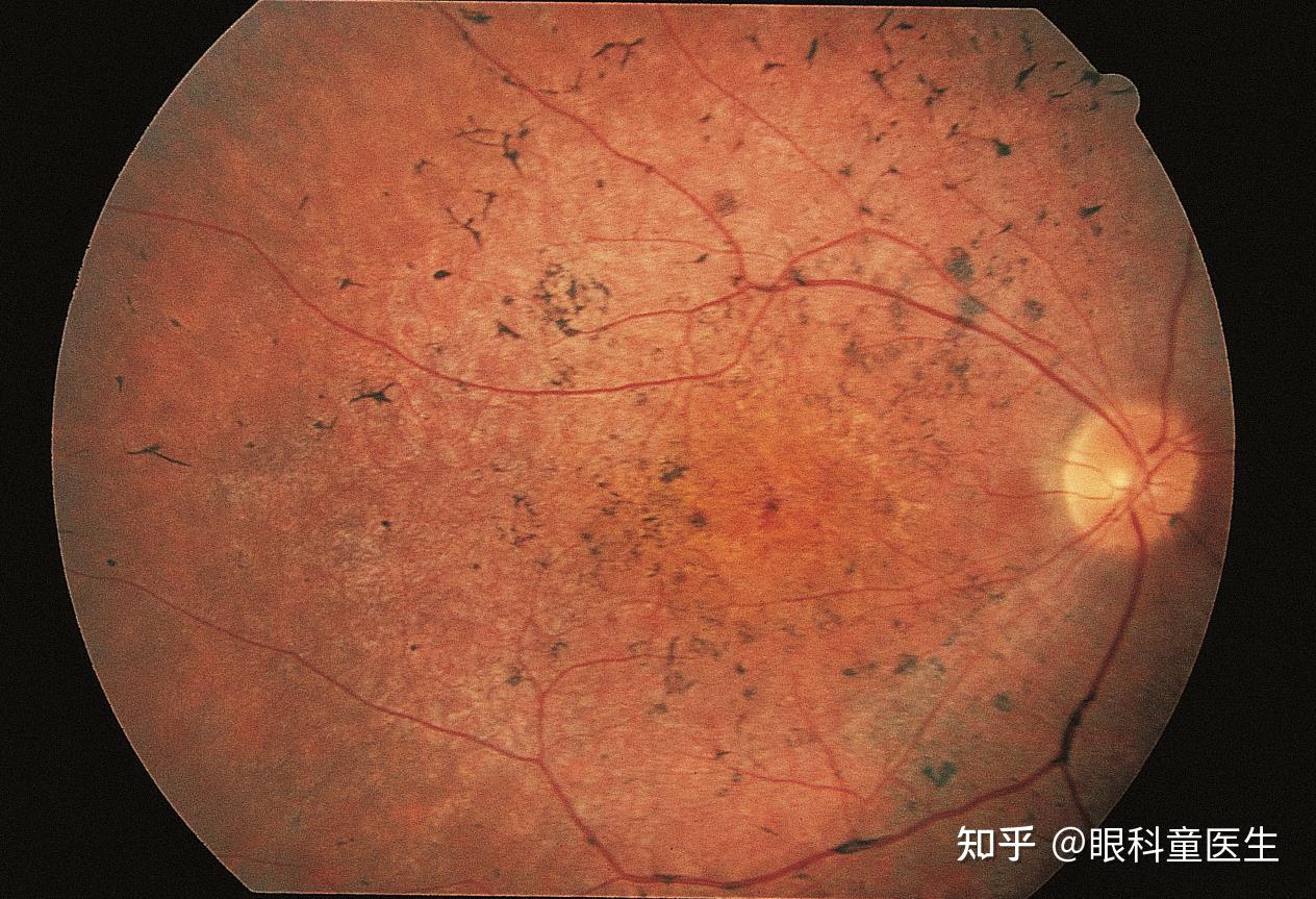 視網膜變性病變5錐細胞營養不良