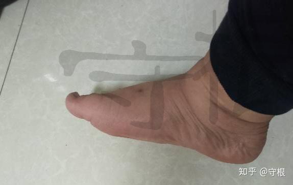 脚宽运动男皮鞋特宽脚型量脚定制运动手工皮鞋案例