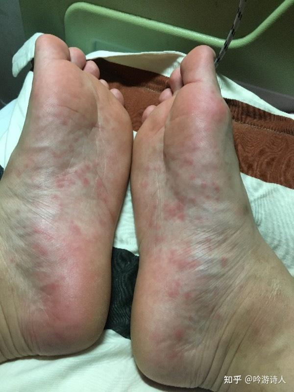 水疱型脚气水泡能扎破吗?