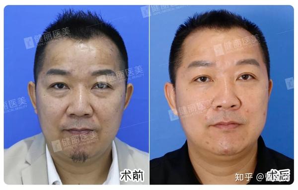 做完眼袋再去参加戛纳电影节,时间来得及吗?