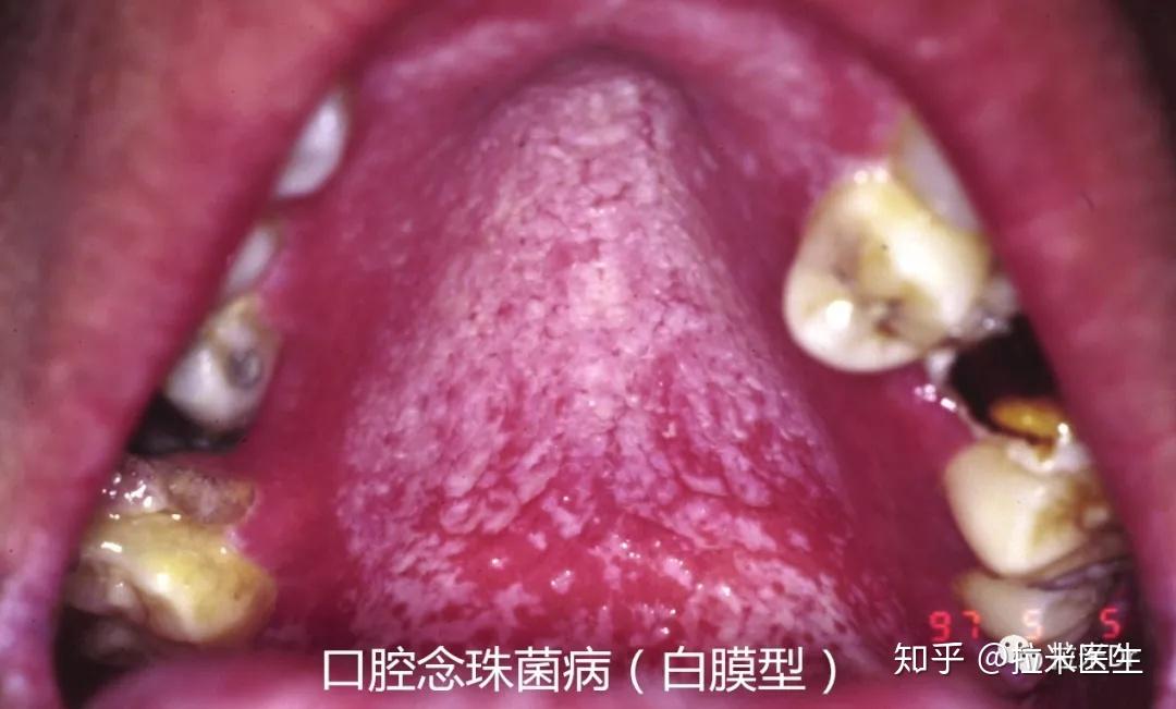 口腔毛狀白斑(ohl)是艾滋病患者特徵性口腔損害,與eb病毒,人乳頭瘤