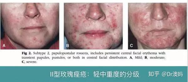 玫瑰痤疮终极指南 - 知乎