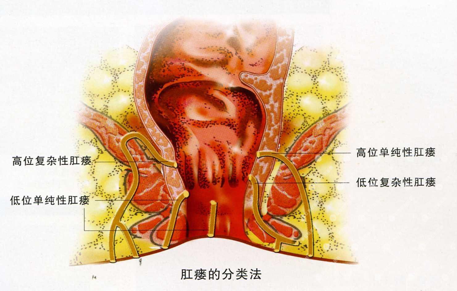 肛门囊肿怎么引起的图片