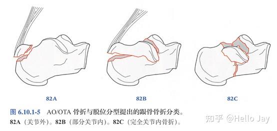 跟骨骨折的治疗原则 - 知乎