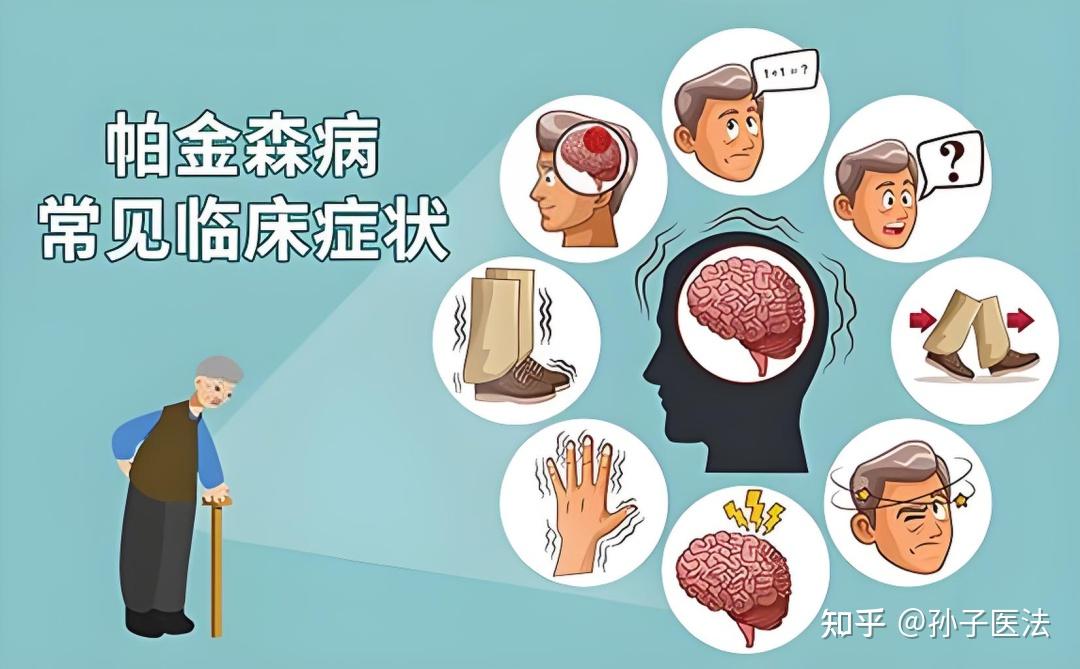 磁波刀关爱大使 | 解密帕金森病:抖!僵直!活动迟缓!哪一个症状都难受! - 知乎