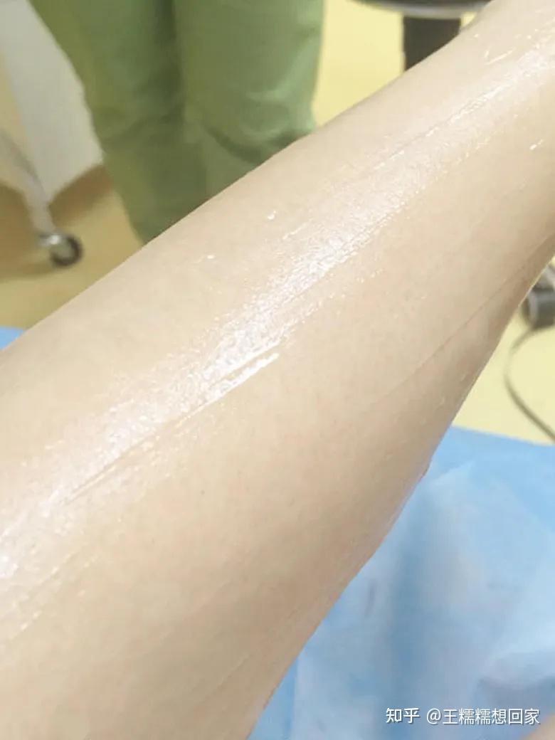 脱毛后涂身体乳过敏怎么办(脱毛后涂身体乳过敏怎么办呢)