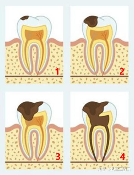 洞的深淺,治療方法也不一樣,如下圖:而每一個牙齒都是有牙釉質,牙本質