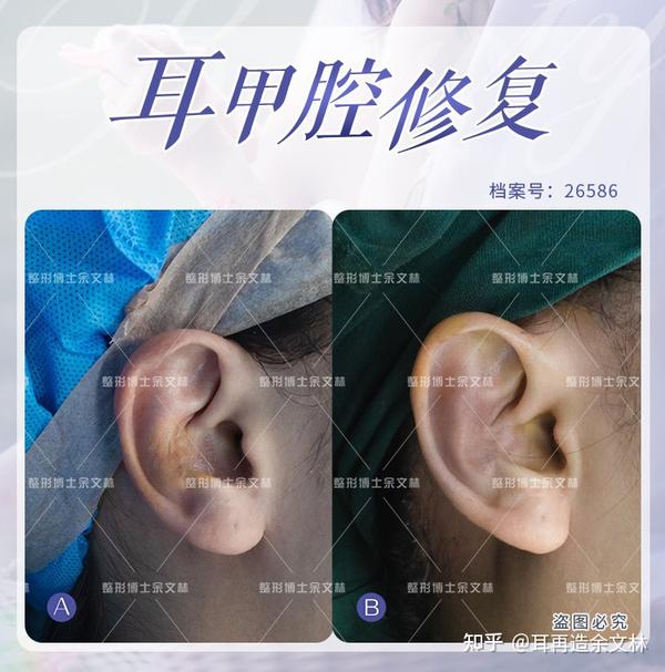 【案例分析】耳朵甲腔软骨变形难看?耳再造手术让耳朵恢复正常形态 - 知乎
