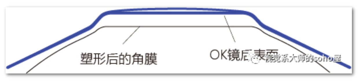 视光冷知识丨矢高设计ok镜的设计思路和数学推演