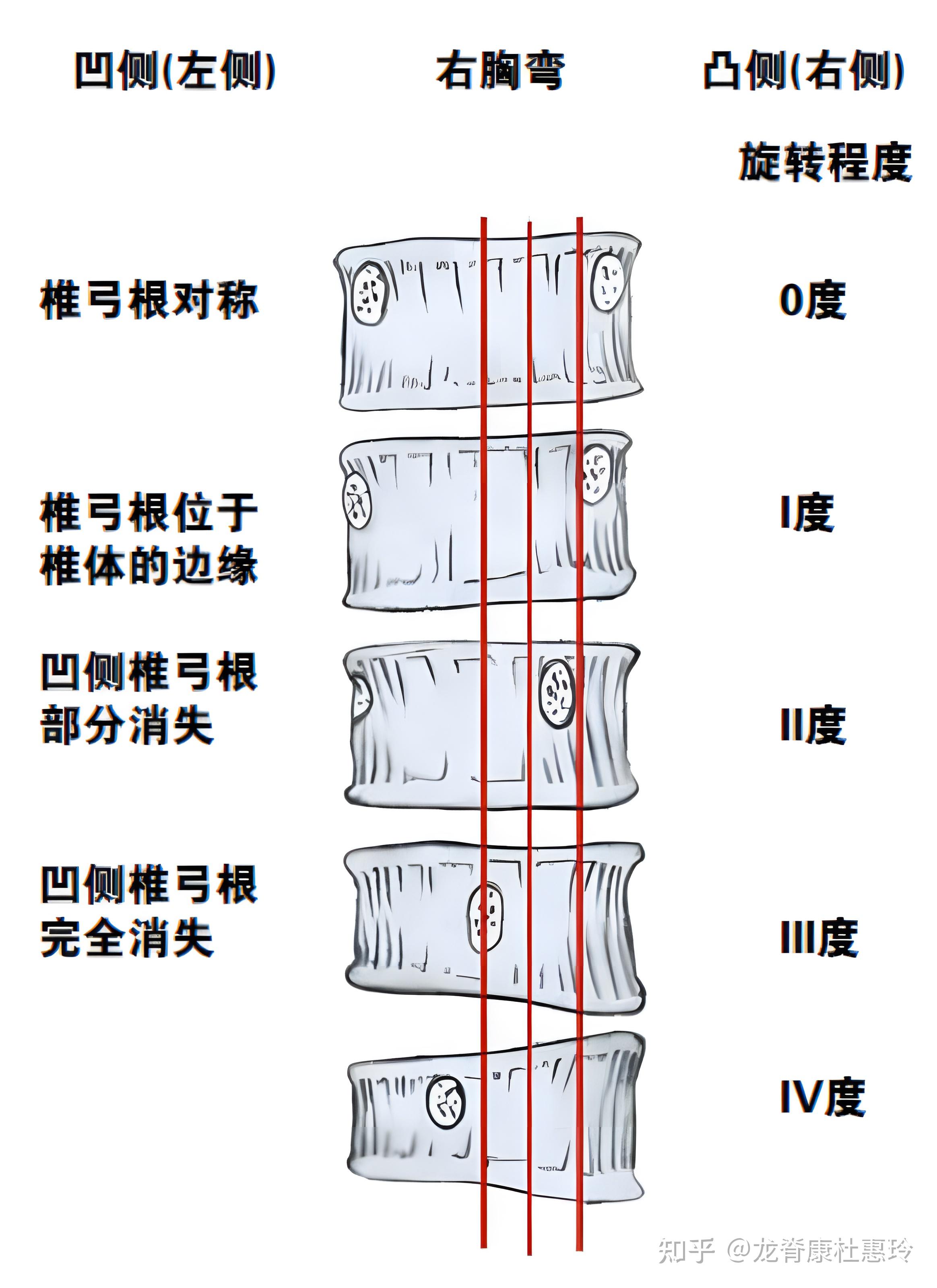 严重的椎体旋转