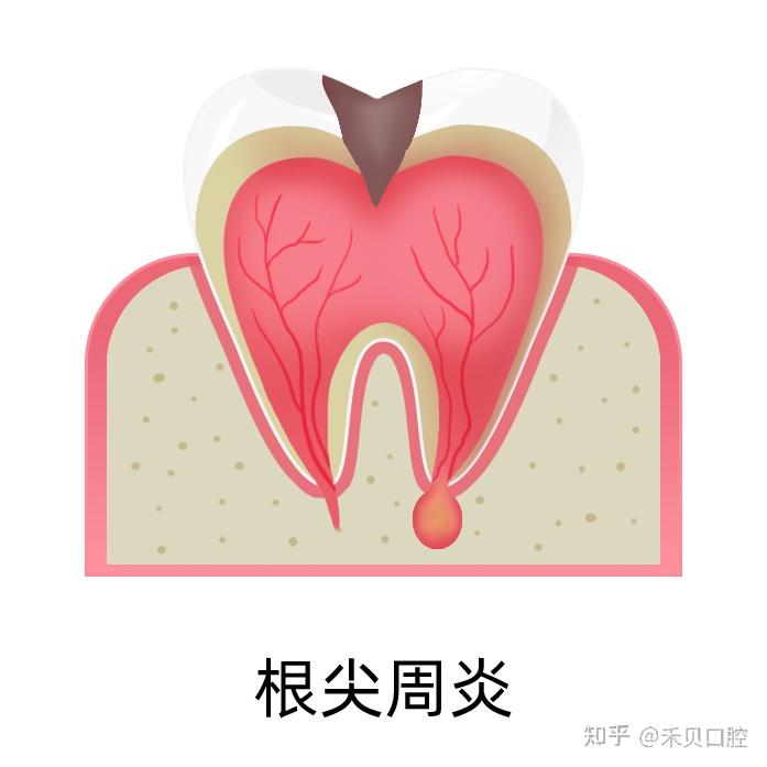 根尖周炎与牙髓炎的区别！ - 知乎