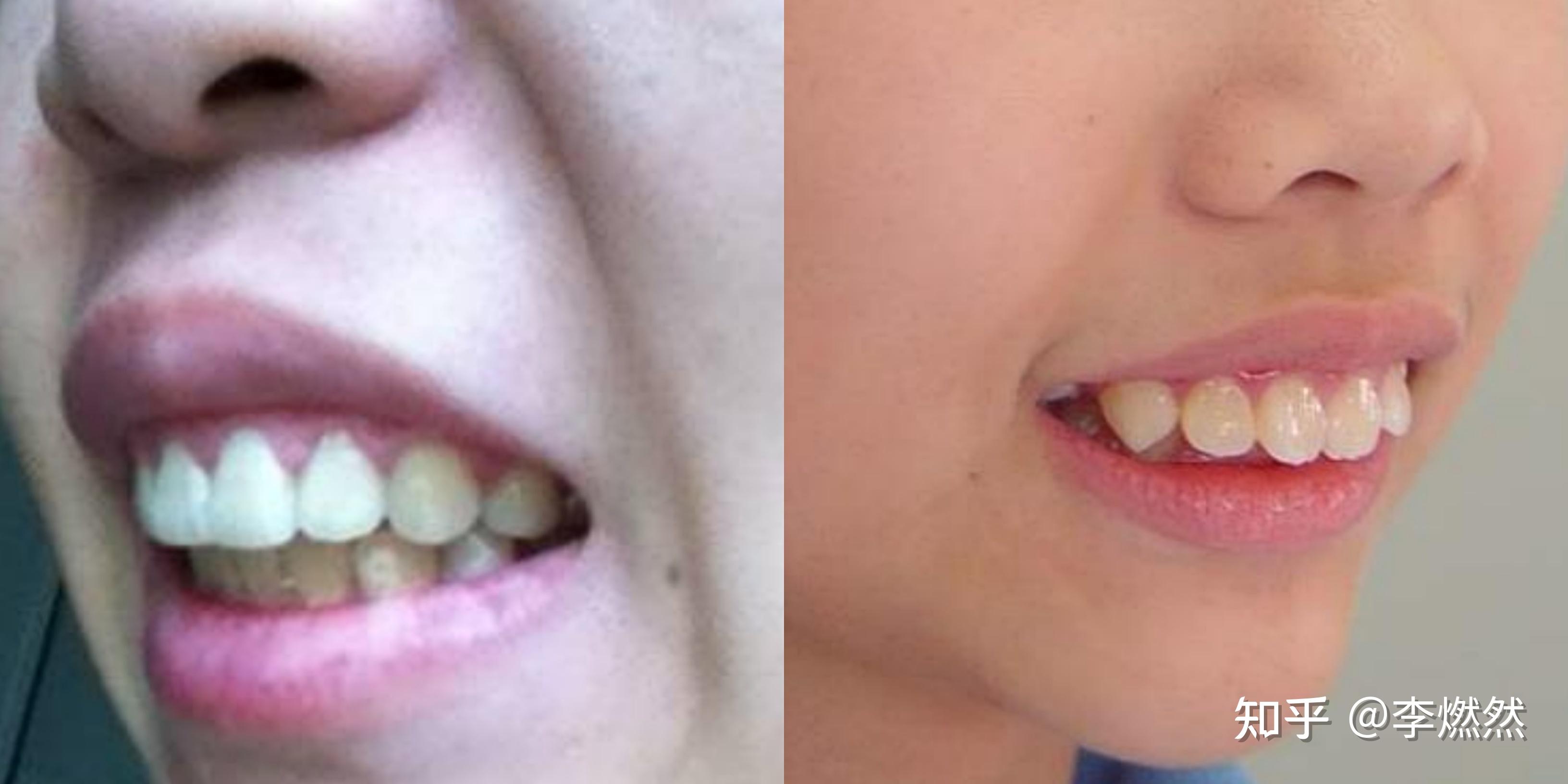 戴牙套可以改善牙齿外凸的程度是多大？（有图） - 知乎