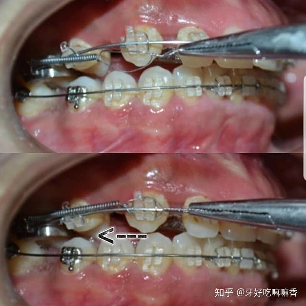 這種彈力橡皮圈是掛在矯治裝置(託槽,牽引鉤)之間,產生彈力用於牙齒和