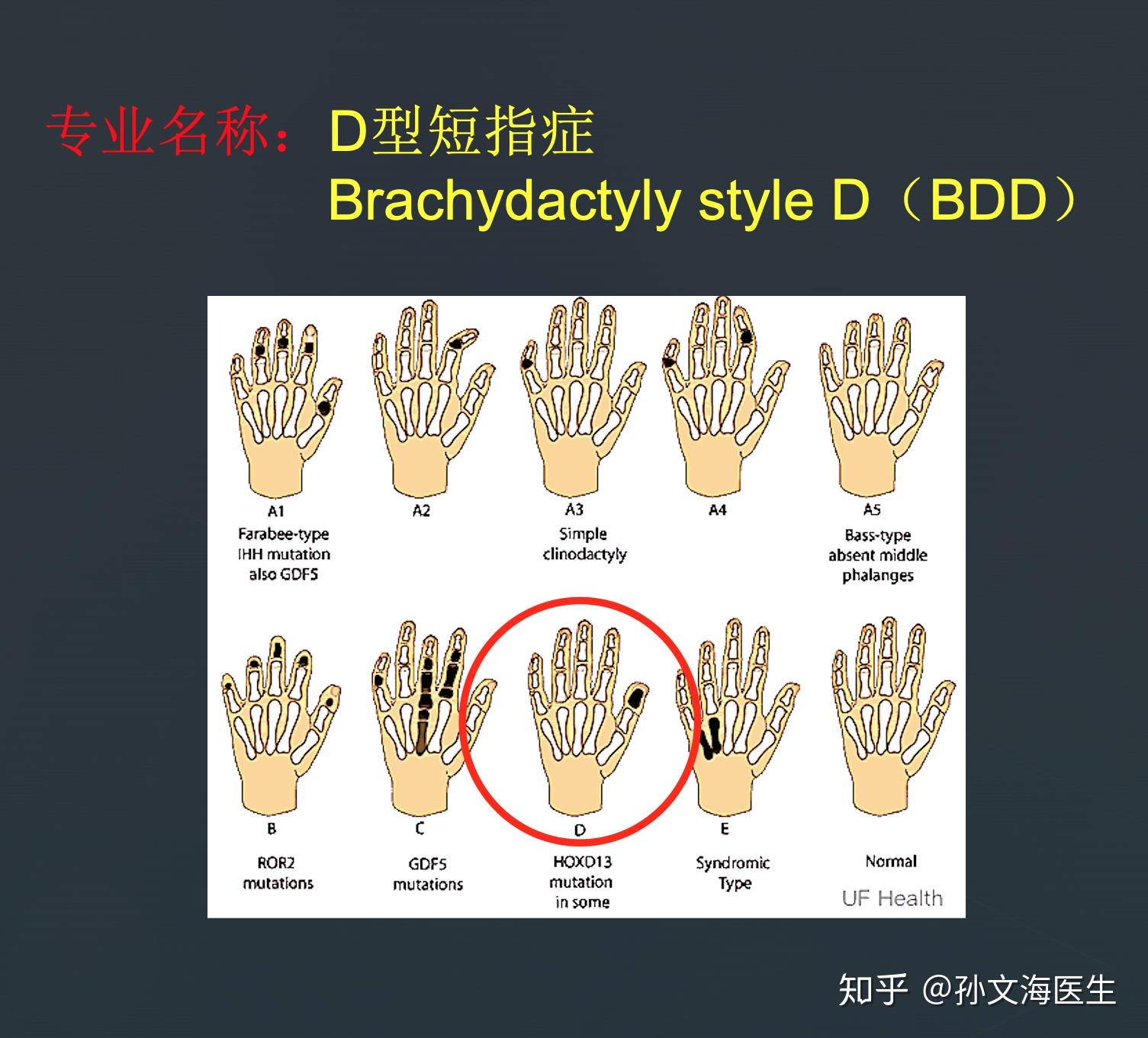 d型短指症的命名