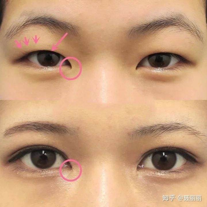 怎么判断我究竟需不需要开眼角呢