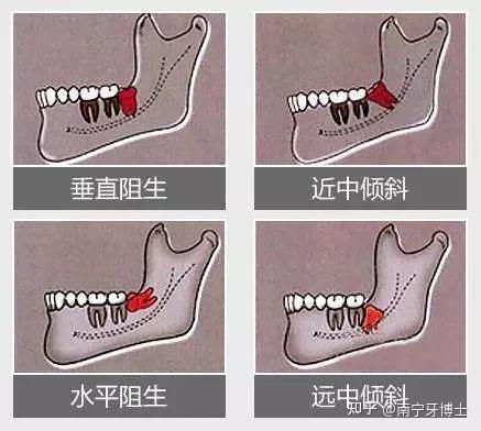 大板牙是什么意思图片